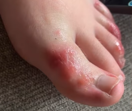 Covid toe : Τι είναι το δυσάρεστο σύμπτωμα που εμφανίζουν κάποιοι ασθενείς – Αποτελεί ένδειξη της Covid-19;