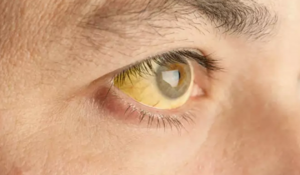 Κίτρινα μάτια : Πού οφείλεται το σύμπτωμα αυτό – Ποιοι πρέπει να προσέχουν