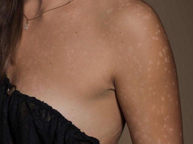 Ψωρίαση : Τι είναι και γιατί εκδηλώνεται