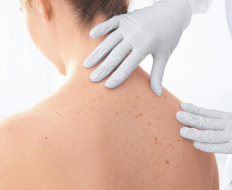 Πότε βγαίνουν οι κόκκινες ελιές στο δέρμα και τι να προσέξετε