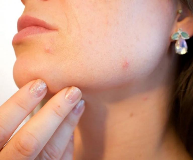 Δυσανεξία σε τροφές : Πώς το δέρμα του προσώπου σας «αντιδρά» σε ορισμένα φαγητά