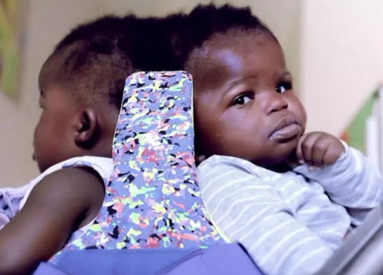 Ιταλία: Σιαμαία δίδυμα ενωμένα στο κεφάλι διαχωρίστηκαν επιτυχώς