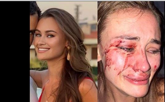 Εικόνες – σοκ: Μοντέλο πήγε στην Τουρκία και ξυλοκοπήθηκε άγρια