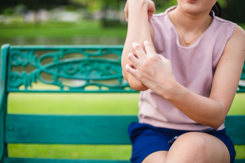 Ανακουφιστείτε από τα τσιμπήματα με φυσικούς τρόπους