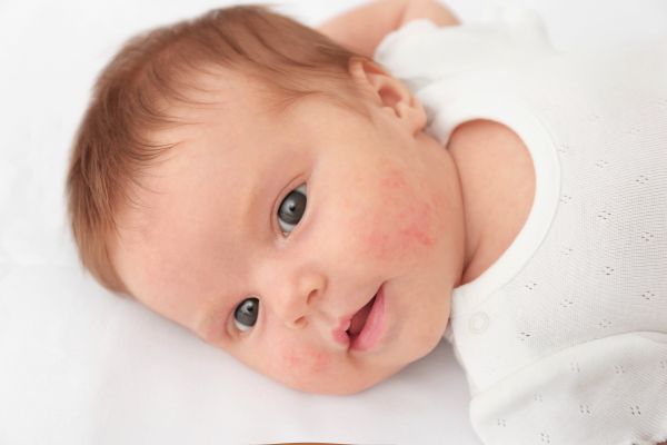Μήπως το μωρό έχει αλλεργία;