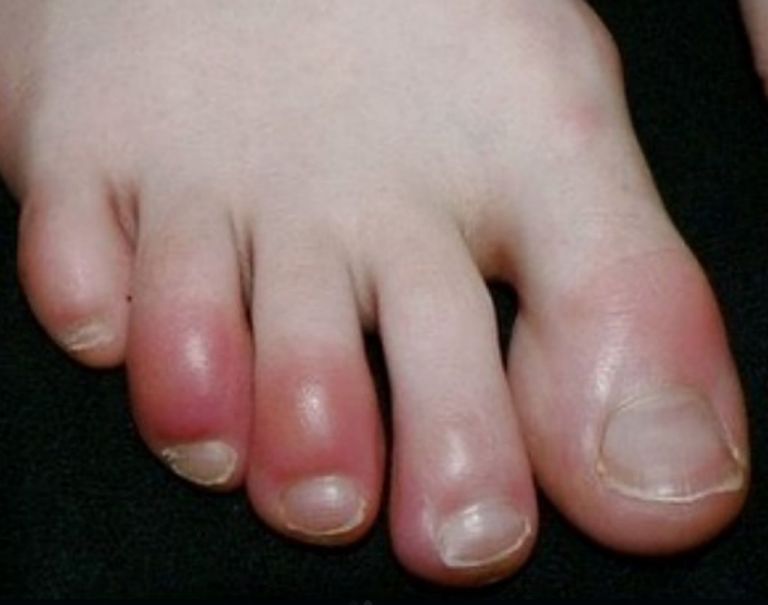 Κοροναϊός : Τα σημάδια που προκαλεί πάνω στο δέρμα