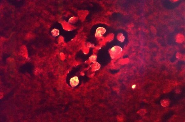 Η τρομακτική κατάσταση που βιώνουν ασθενείς, μήνες μετά τον κοροναϊό