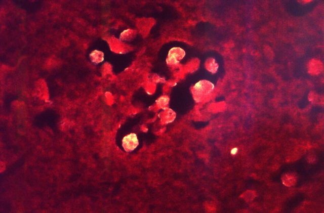 Η τρομακτική κατάσταση που βιώνουν ασθενείς, μήνες μετά τον κοροναϊό