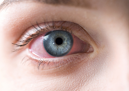 Κοροναϊός : Μπορεί ο ιός να μολύνει τα μάτια;