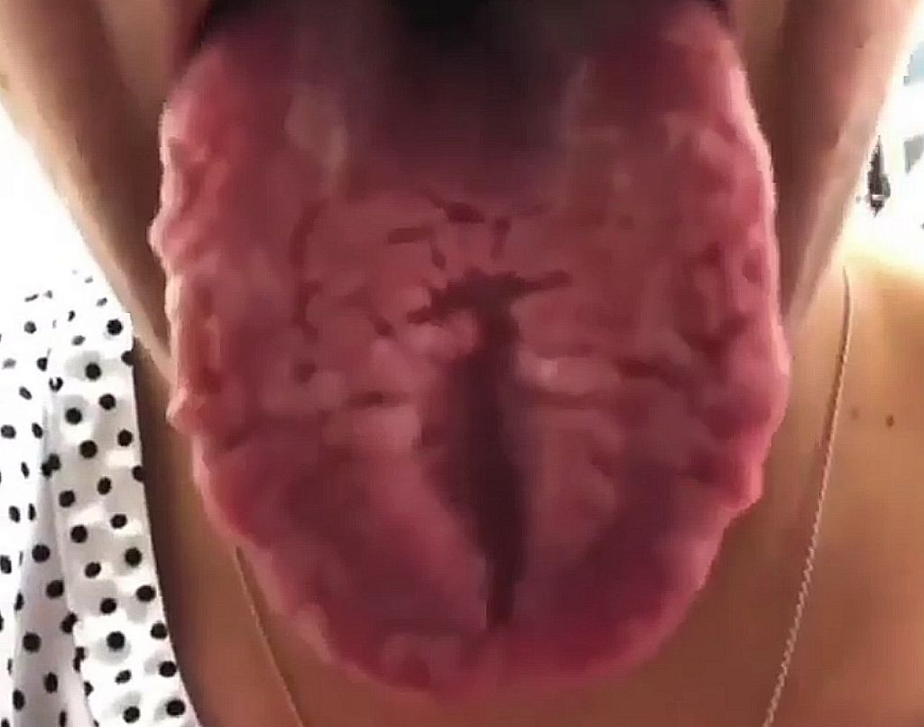 Ρωγμές στη γλώσσα : Τι εξηγεί την εμφάνισή τους ;