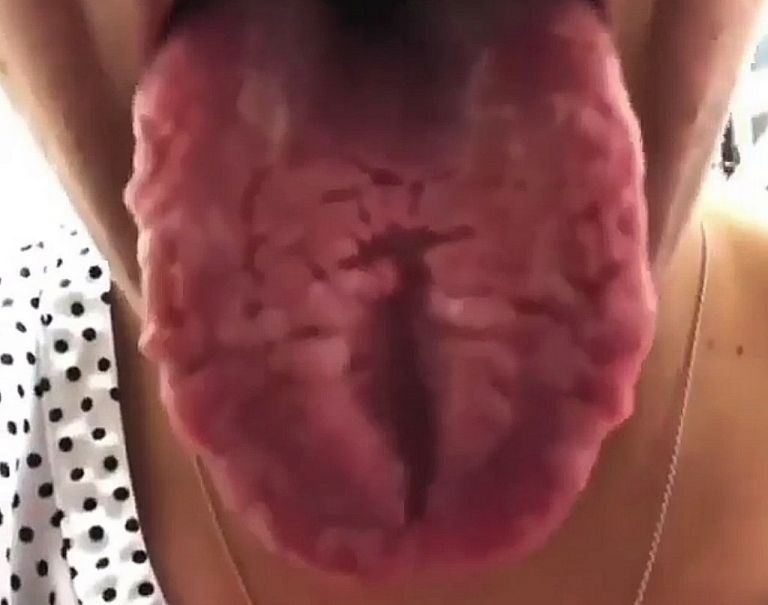 Ρωγμές στη γλώσσα : Τι εξηγεί την εμφάνισή τους ;