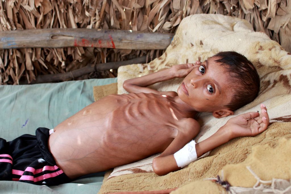 Εκατοντάδες χιλιάδες παιδιά θα πεθάνουν από πείνα λόγω της πανδημίας