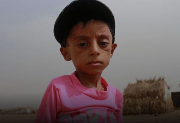 Υεμένη : Η πείνα στοιχειώνει τα παιδιά της χώρας – Η συγκλονιστική ιστορία του 10χρονου Χάσαν