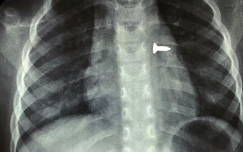 Κρήτη : Τρίχρονο κοριτσάκι κατάπιε βίδα που κατέληξε στον αριστερό της πνεύμονα