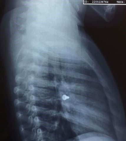 Κρήτη : Τρίχρονο κοριτσάκι κατάπιε βίδα που κατέληξε στον αριστερό της πνεύμονα