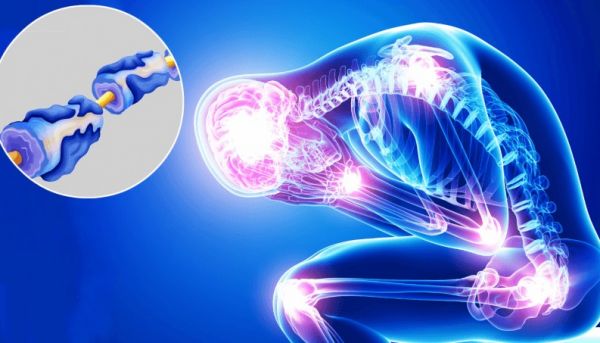 Σύνδρομο Guillain-Barre: Τι συμβαίνει με την αιφνίδια παράλυση των άκρων