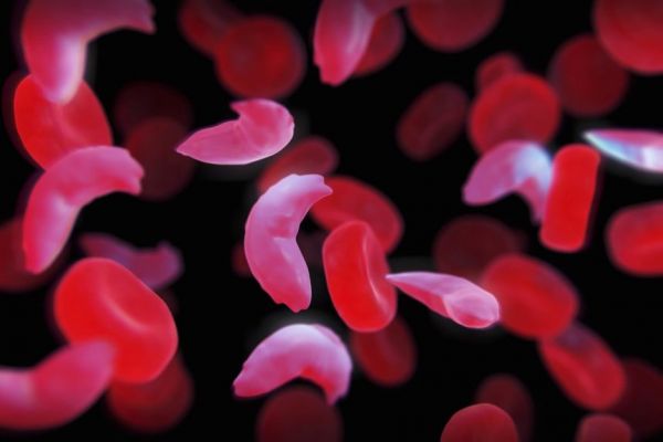 Προσωρινή διακοπή σε γονιδιακή θεραπεία για την δρεπανοκυτταρική αναιμία