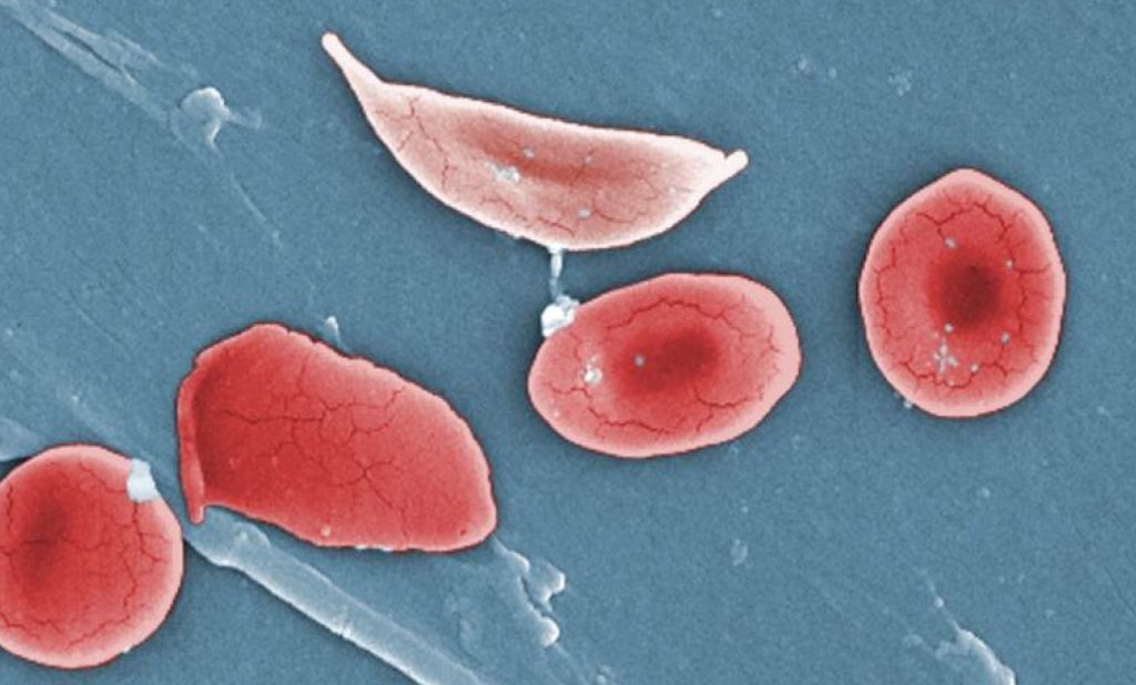 Αίτημα σε FDA και ΕΜΑ για συνέχιση μελέτης για τη δρεπανοκυτταρική αναιμία