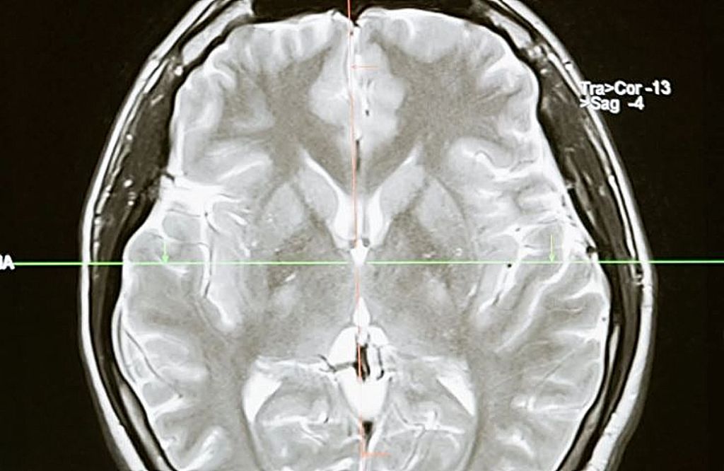 Covid-19 : Όσοι είχαν μακροχρόνια συμπτώματα υποφέρουν κατά 81% από επίμονα νευρολογικά προβλήματα