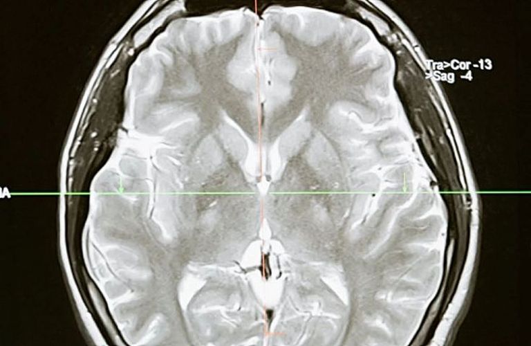Covid-19 : Όσοι είχαν μακροχρόνια συμπτώματα υποφέρουν κατά 81% από επίμονα νευρολογικά προβλήματα
