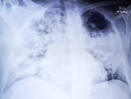 Γιατρός σοκαρίστηκε από τον κοροναϊό : Αυτή είναι η ακτινογραφία 59χρονου που πέθανε μέσα σε λίγες ώρες