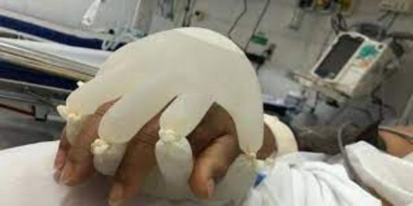 Κοροναϊός : Γάντια γεμάτα με ζεστό νερό «κρατάνε» το χέρι των ασθενών – Θυμίζουν το ανθρώπινο άγγιγμα