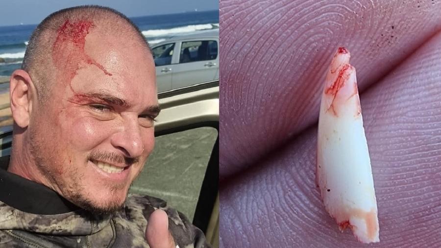 Δύτης βγάζει δόντι καρχαρία από το κρανίο του μετά από επίθεση- Βίντεο