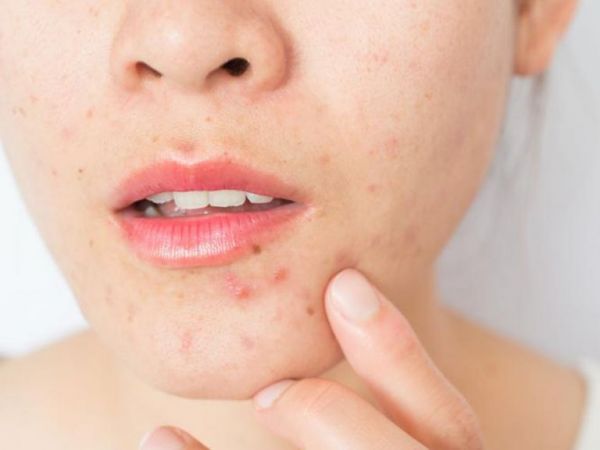 Τι φταίει για τα σπυράκια στο πρόσωπο; – Μάθετε πώς θα τα εξαφανίσετε