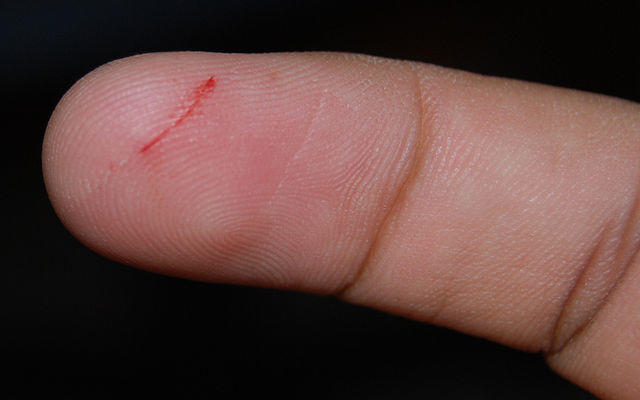 Κόψατε το δάκτυλό σας με το μαχαίρι; – Βάλτε αυτό και θα «σωθείτε»
