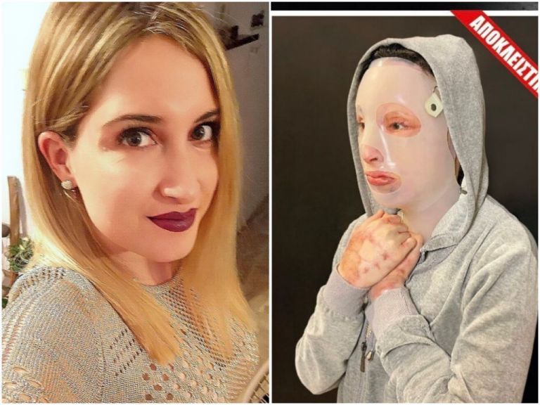 Επίθεση με βιτριόλι: «Η Ιωάννα δεν μπορεί να βγει στο φως, πονάει πάρα πολύ» λέει ο δικηγόρος της