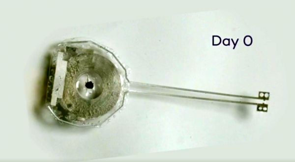 Πρωτοποριακός βηματοδότης αυτοκαταστρέφεται όταν πάψει να χρειάζεται