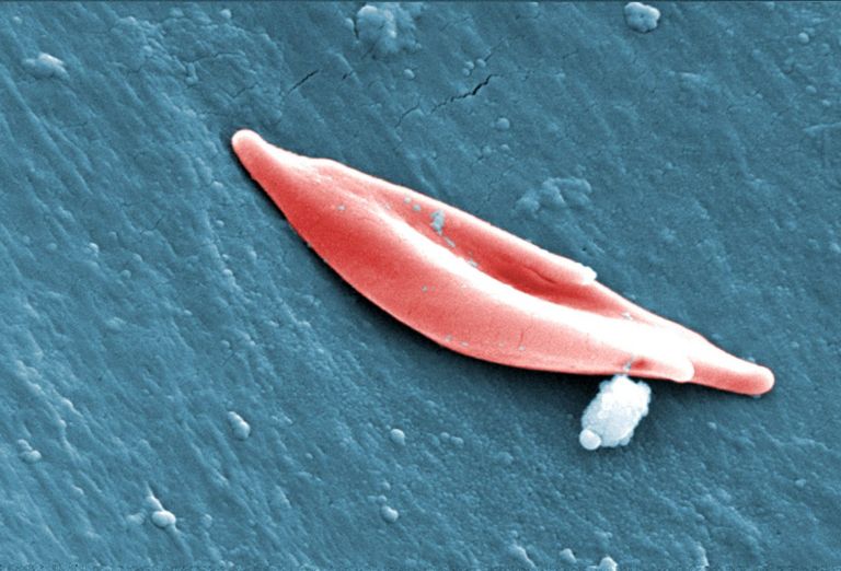 Στο σπίτι περνούν τις κρίσεις τους οι ασθενείς με δρεπανοκυτταρική νόσο