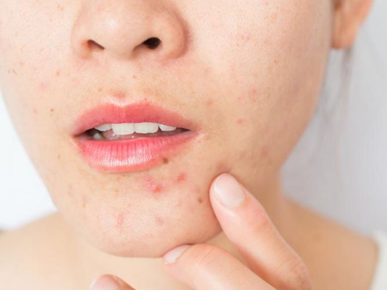 Σπυράκια στο πρόσωπο: Πώς να απαλλαγείτε σε λίγες ώρες
