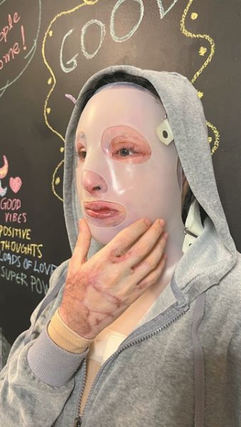 Επίθεση με βιτριόλι – Ιωάννα: «Δύναμή μου είναι οι άνθρωποι και η αλληλεγγύη τους»