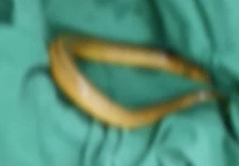 Κίνα: Έβαλε στον πρωκτό του χέλι 20 εκατοστών για να… θεραπευτεί