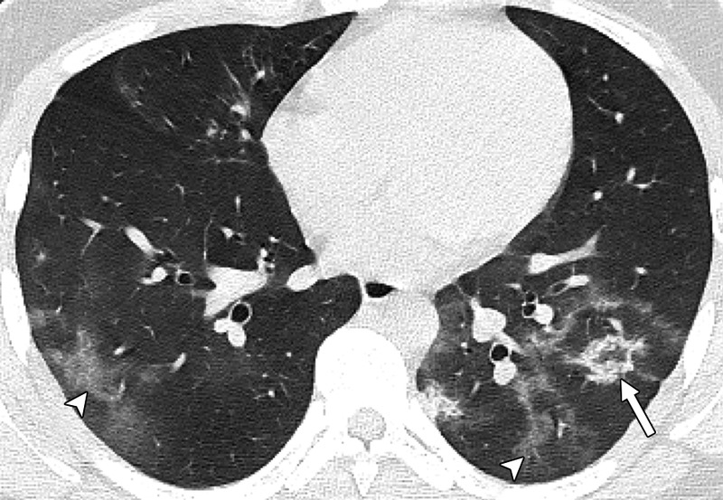 Ανάρτηση σοκ Μαγιορκίνη – Δείτε τις βλάβες στους πνεύμονες ανήλικων που νόσησαν με κοροναϊό