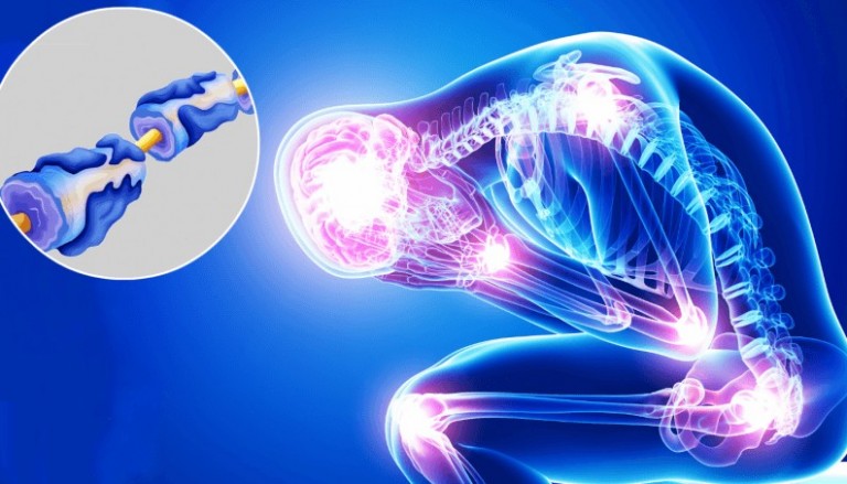 Κοροναϊός – Πιθανή αύξηση κινδύνου για σύνδρομο Γκιγιέν-Μπαρέ