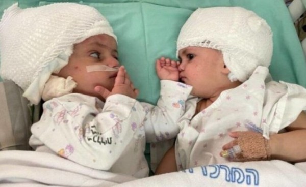 Σπάνια εγχείρηση – Σιαμαία ενωμένα στο κεφάλι κοιτάχτηκαν για πρώτη φορά