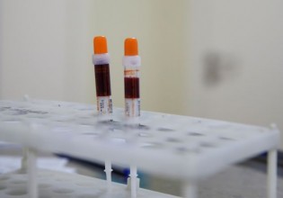 Κοροναϊός – Νέο τεστ αίματος αυτο-αντισωμάτων μπορεί να προβλέψει την πιθανότητα σοβαρής νόσησης