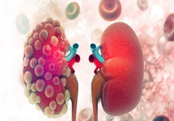 Αυξάνονται οι αιμοκαθάρσεις λόγω κοροναϊού – Φόβοι για ανάγκη μεταμοσχεύσεων