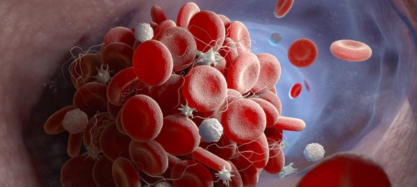 Κοροναϊός – H γενετική προδιάθεση για νόσο «εγκυμονεί» θρομβώσεις