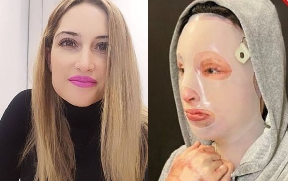 Ιωάννα Παλιοσπύρου – Δημοσίευσε σοκαριστικές φωτογραφίες μετά την επίθεση με το βιτριόλι [σκληρές εικόνες]