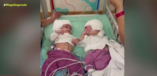 Ισραήλ – Σιαμαία ενωμένα στο κεφάλι είδαν για πρώτη φορά το ένα το άλλο