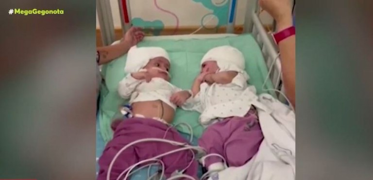 Ισραήλ – Σιαμαία ενωμένα στο κεφάλι είδαν για πρώτη φορά το ένα το άλλο