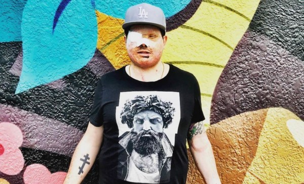 Ανδρέας Χριστοφέρος – Συγκλονίζει μιλώντας για την επίθεση με οξύ που έχει δεχτεί – Το μήνυμά του στην Ιωάννα Παλιοσπύρου