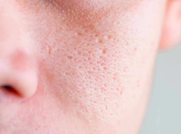 Πόροι στο πρόσωπο – Οι αιτίες τους και πώς αντιμετωπίζονται
