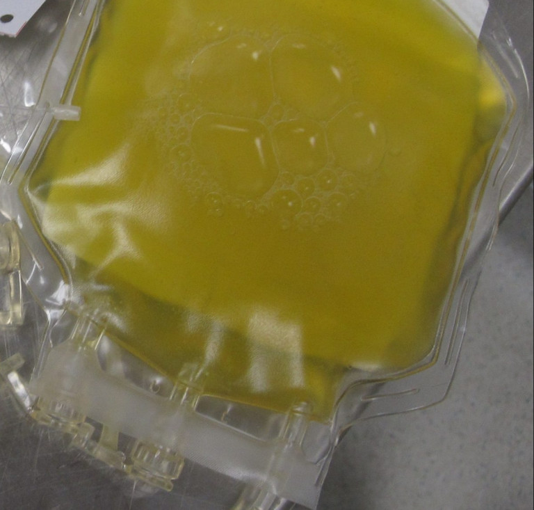 Δεν βοηθά τους σοβαρά ασθενείς με COVID – 19 το πλάσμα όσων έχουν αναρρώσει