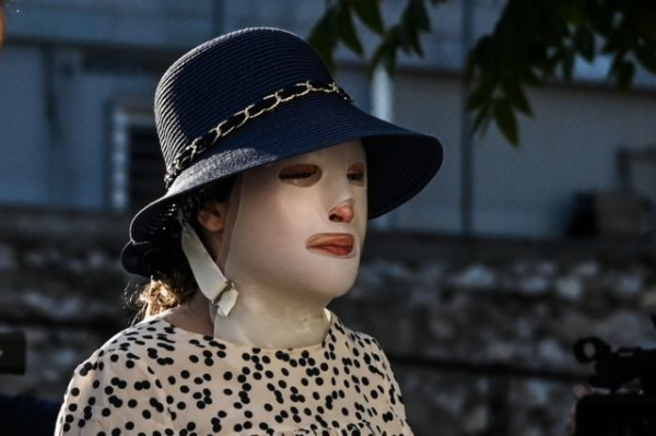 Επίθεση με βιτριόλι – «Καίνε» τη δράστρια οι καταθέσεις των γιατρών – «Διέτρεξε κίνδυνο ζωής»