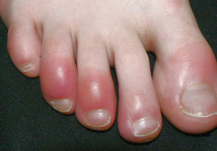 Κοροναϊός  – Πώς ο κοροναϊός μπορεί να προκαλέσει βλάβες σαν χιονίστρες