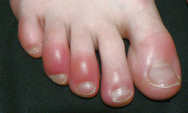 Κοροναϊός  – Πώς ο κοροναϊός μπορεί να προκαλέσει βλάβες σαν χιονίστρες